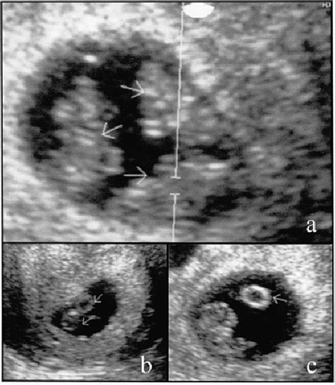 Ultrasound Quintuplets