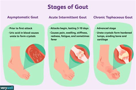 Gout: Symptoms, Pictures, Treatment, and More