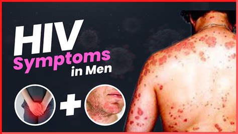 Aids Symptoms In Men