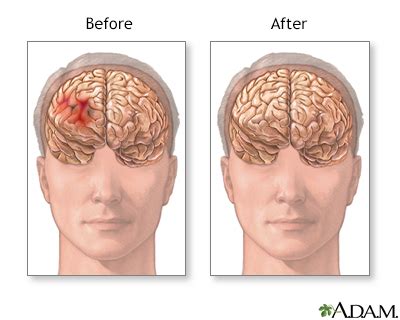 Brain surgery Information | Mount Sinai - New York