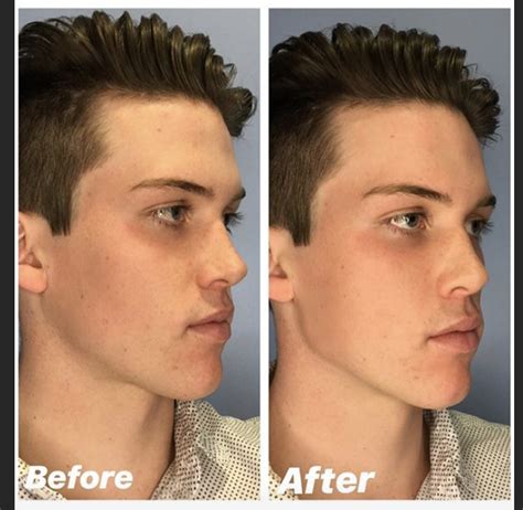 We see a lot of requests to enhance the shape of the jawline. For men ...