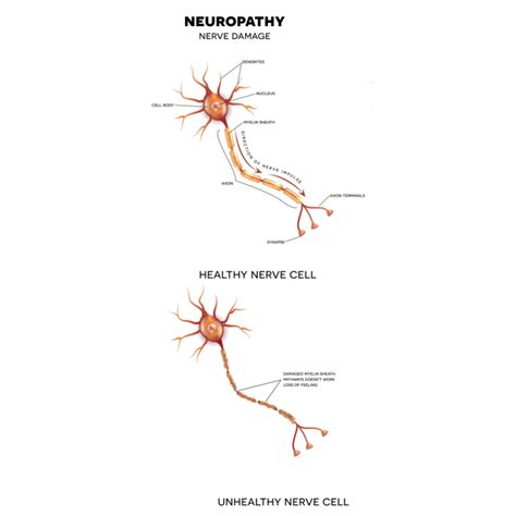 What are the Most Common Causes of Nerve Damage? - Premier Neurology ...