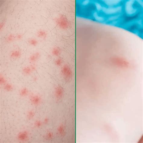 Bed Bug Bites Vs Hives - Bed Bugs Sprays