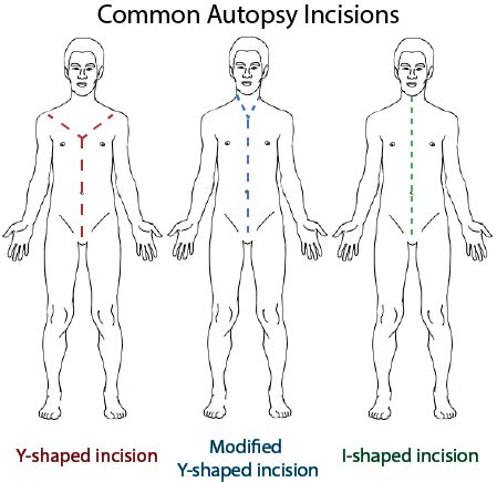 Autopsy Procedure & Results | What is an Autopsy? - Video & Lesson ...