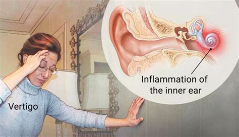 Vertigo / Inflammation of the Inner Ear | Snail in My Ear Telling Me ...