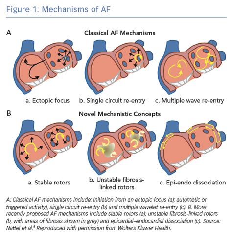 Mechanisms of AF | Radcliffe Cardiology