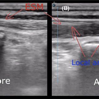 Ultrasound‐guided Erector Spinae Plane Block using a high‐frequency ...