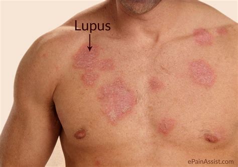 Lupus: Causes, Signs, Symptoms, Treatment, Lifestyle Modifications