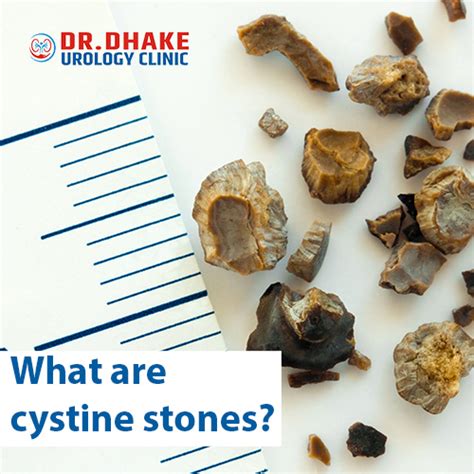 Cystine Stones – Causes, And Treatment Options - Dr. Rajesh Dhake