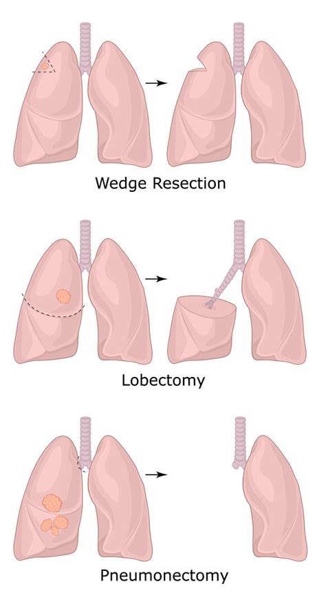 Lung Cancer — Specialist Centre Ballarat · General Surgery | Colorectal ...