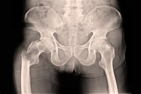 Hip Fractures - AdFrac