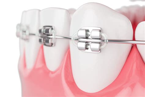 Traditional Braces - https://losal-dds.com/