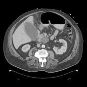 Gallbladder perforation | Radiology Reference Article | Radiopaedia.org