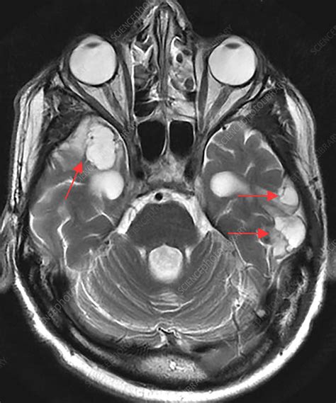 Chronic Post-Traumatic Brain Injury, MRI - Stock Image - C030/6076 ...