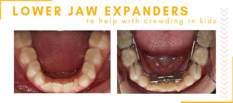 Bottom Palate Expander