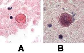 Diagnosis & Detection | Balamuthia | Parasites | CDC