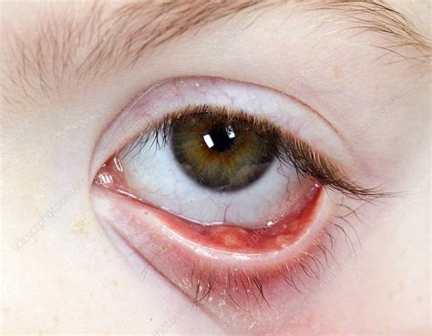 Chalazion in the lower eyelid - Stock Image - C016/6853 - Science Photo ...