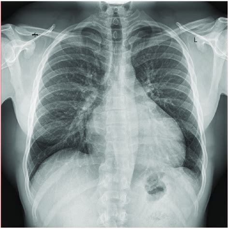 Chest X-ray of Patient 2: anteroposterior view. Kerley B lines are ...