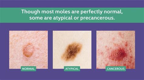 What Does An Unhealthy Mole Look Like? Spotting Warning Signs