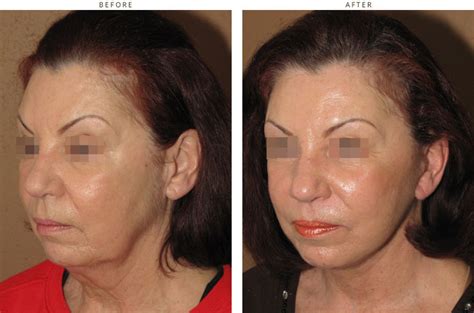 Mini Face Lift – Before and After Pictures * | Dr Turowski - Plastic ...