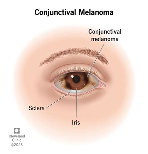 Conjunctival Melanoma: Symptoms & Treatment