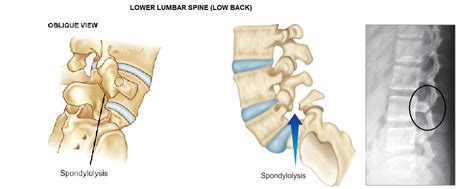 SPONDYLOLYSIS EXERCISES, CAUSES, SYMPTOMS AND TREATMENT