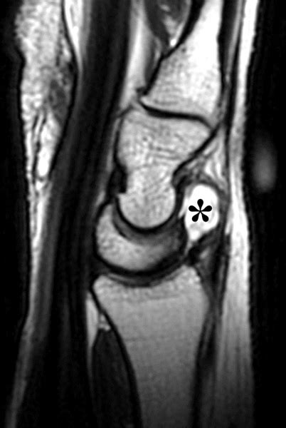 Ganglion Cyst Mri | SexiezPicz Web Porn