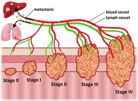 Colorectal Cancer Progression