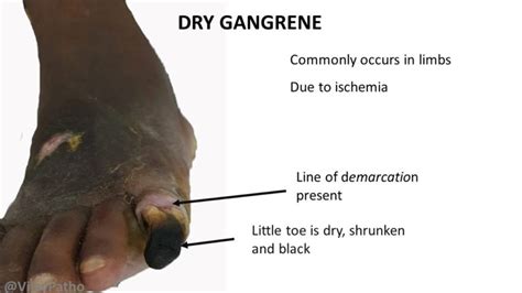 PATHOLOGY OF GANGRENE - Pathology Made Simple