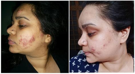 My Battle with Painful Cystic Acne - Beauty Barn Blog