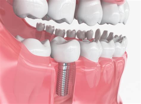 Tooth Implant Types