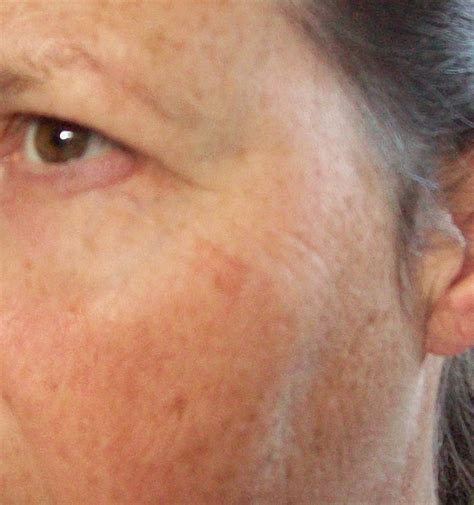 shingles on face images - pictures, photos