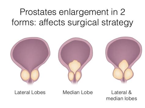 BPH treatments that safer, preserve ejaculation and help urinary symp…