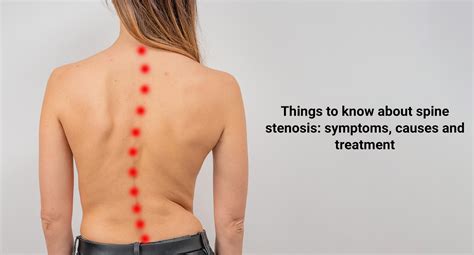 Things to know about spine stenosis: symptoms, causes and treatment ...