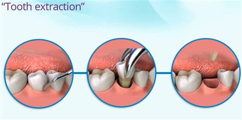 Wisdom Tooth Extraction in West Roxbury | ABS Boston