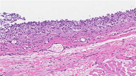 Mucocele Histology