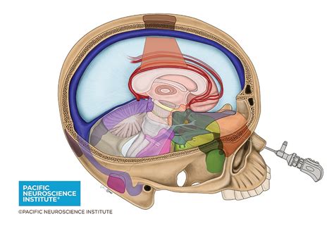 Largest Study of Brain Tumor "Keyhole" Surgery for Meningiomas ...