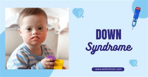 Down Syndrome (Trisomy 21) | Anthroholic