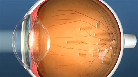 Vitrectomy Eye Surgery for Floaters | Retina Doctor Melbourne