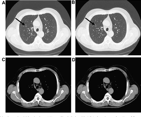 Figure 2 from Low dose chest CT protocol (50 mAs) as a routine protocol ...