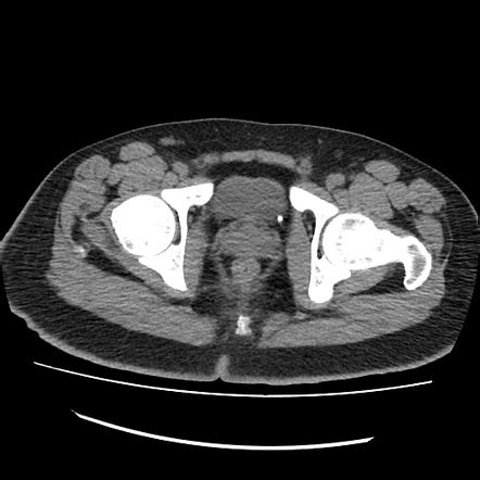 Vesicoureteric junction calculus | Radiology Case | Radiopaedia.org