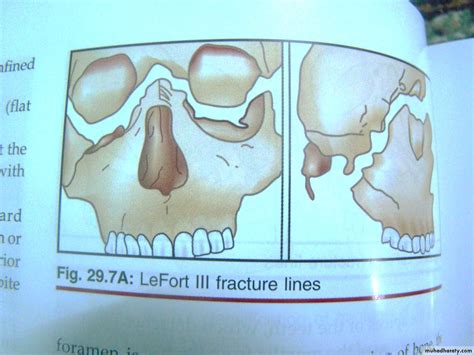 Fracture maxilla pptx - Dr.Wafaa - Muhadharaty