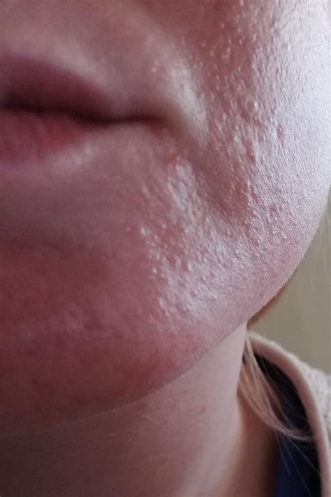 [Skin concerns] Very tiny bumps on face after retinol use - purging or ...