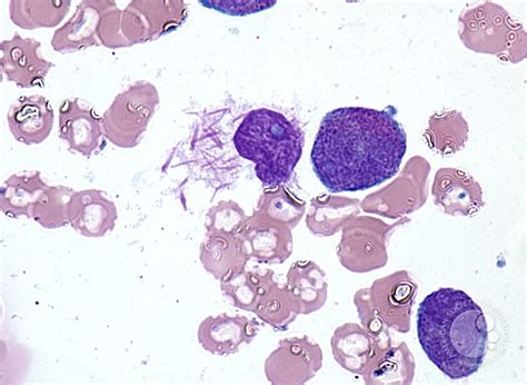 “Flaming” promyelocyte - 1.