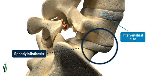 Spondylolisthesis | Spondylolysis | Grades, Causes, Signs & Treatment