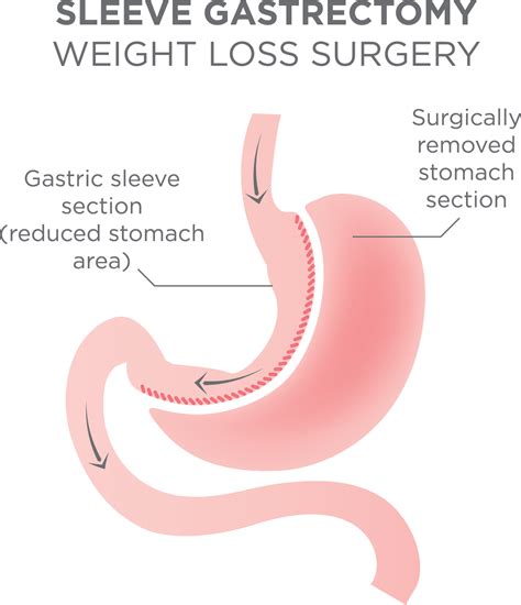 Gastric Sleeve Surgery Near Johnstown and Windber - Chan Soon-Shiong ...