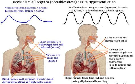 Dyspnea | Current Health Advice, Health Blog Articles and Tips