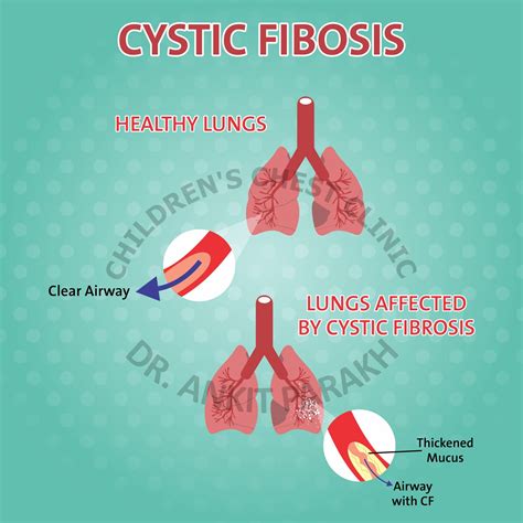 Lung problems in Cystic Fibrosis - symptoms and causes - Dr. Ankit Parakh