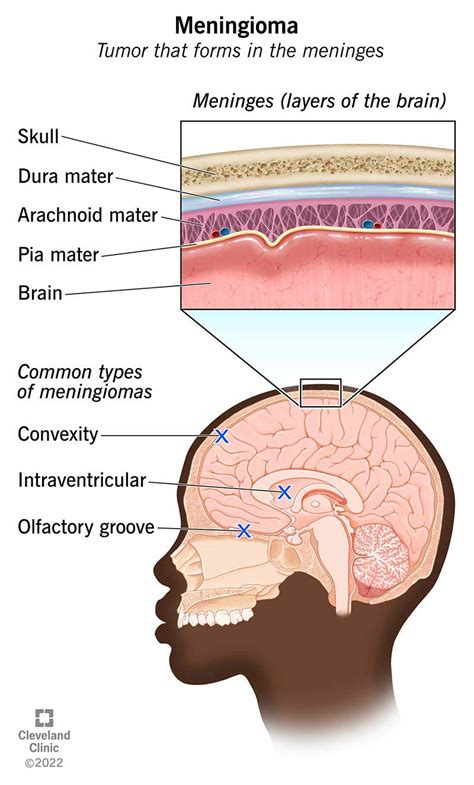 Meningioma: What It Is, Causes, Symptoms & Treatment