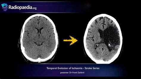 Stroke: Acute infarction - radiology video tutorial (CT, MRI ...